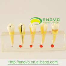 EN-M5 alta qualityresin dental polpa doença clínica modelo para uso de comunicação médico-paciente